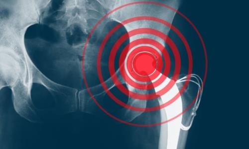 برآورد بار اقتصادی پوکی استخوان در سال 2020 در ایران