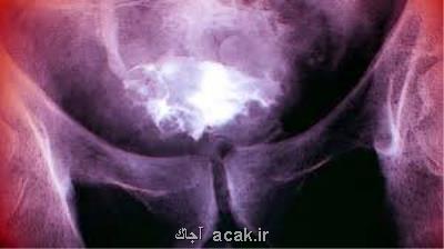 تشخیص سرطان مثانه ۱۰ سال پیش از بروز