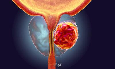 میزان شیوع و عوامل موثر بر بی اختیاری ادرار بعد از جراحی سرطان پروستات