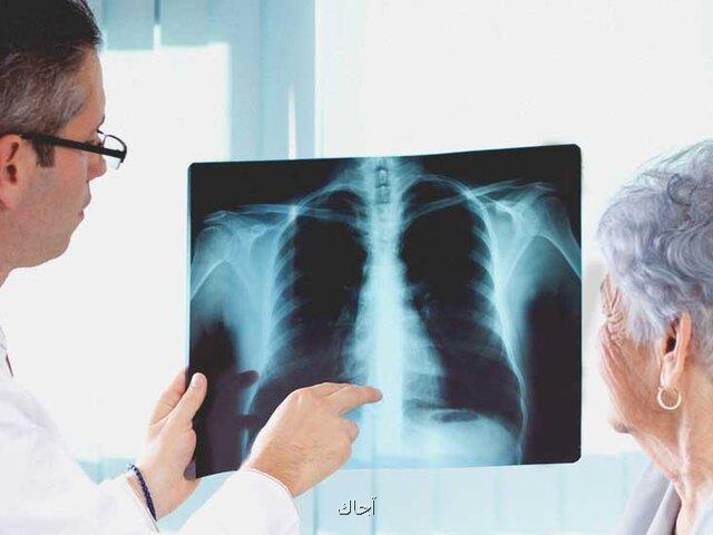احتمال تأثیر یك دارو در پیشگیری از عفونت ریه هنگام مبتلا شدن به كرونا